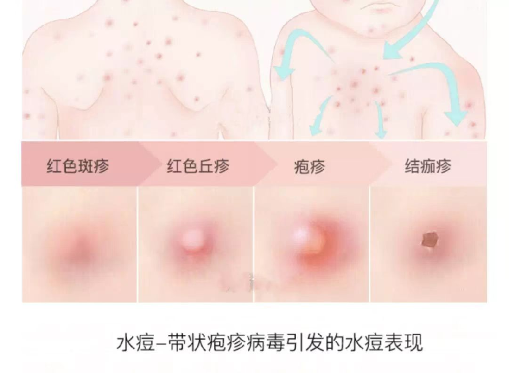 水痘